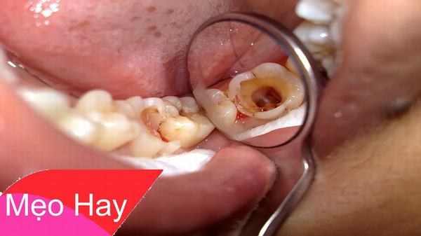 Cổ phương kỳ diệu: Cách làm giảm đau răng nhanh chóng, hiệu quả theo bí quyết Đông y xưa