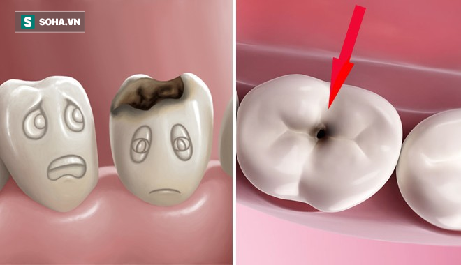 Chuyện gì sẽ xảy ra nếu bạn có một chiếc răng sâu và không chịu chữa trị ngay?