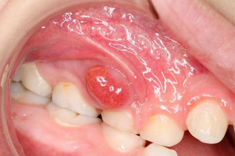 Chuyện gì sẽ xảy ra nếu bạn có một chiếc răng sâu và không chịu chữa trị ngay?